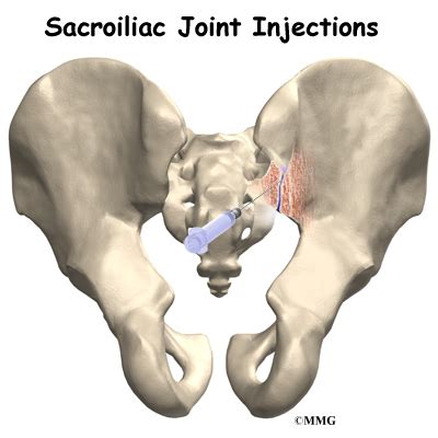 Sacroiliac Joint Injections Midwest Bone And Joint Institute