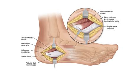 Plantar Fasciitis Surgery And Recovery Heel That Pain