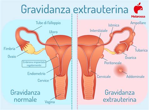 Gravidanza extrauterina cosè cause sintomi e conseguenze