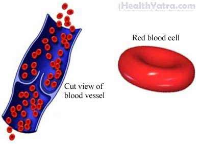 Anemia, Causes, Symptoms, Complications and Cost Surgery ...