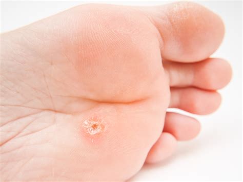Warts And Skin Cancers Corns Calluses Athletes Foot Treatment