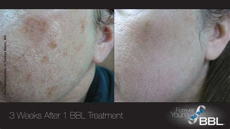 Forever Young Bbl Sciton Laser Acne