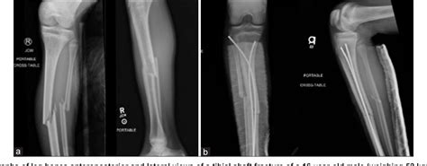 Pediatric Tibial Shaft Fractures Semantic Scholar