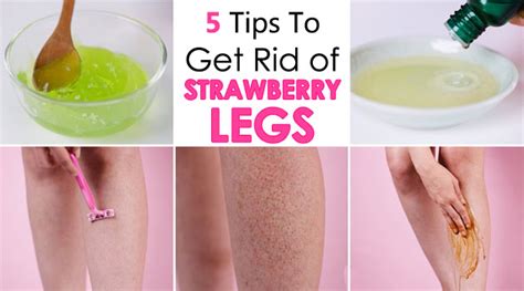 Strawberry Legs 5 Ultimate Tips To Get Rid Of It Getinfopedia