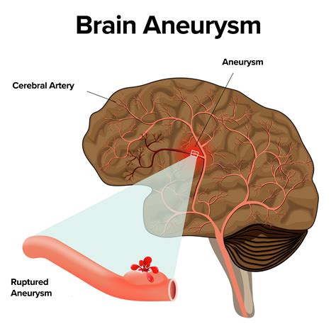 Brain Aneurysm Symptomstreatment Atlantic Brain And Spine