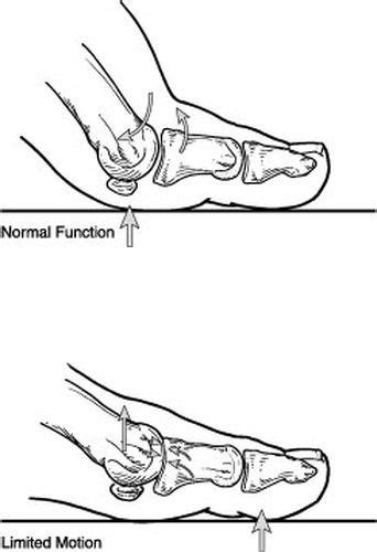 Arthritic Big Toe Joint Hallux Limitus Procare Podiatric Medicine