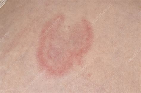 Ringworm Stock Image C0498364 Science Photo Library