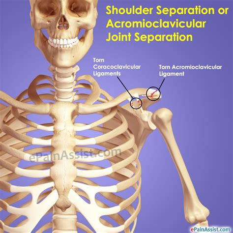 Shoulder Separation Treatment Exercise Causes Symptoms