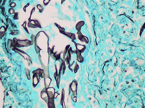 The following is a postmortem image of a patient who had diabetic ketoacidosis and left rhinocerebral mucormycosis. Fatal rhino-orbito-cerebral mucormycosis in a patient with ...