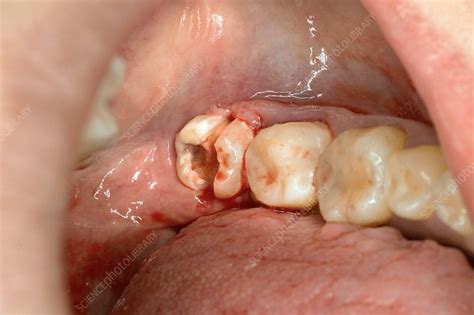 wisdom tooth prepared for extraction stock image c037 3112 science photo library