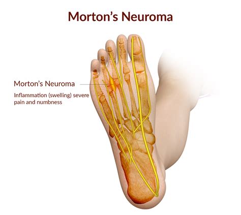 Mortons Neuroma — South West Foot Surgery