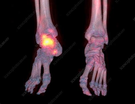 Osteoarthritis Of The Ankle Ct And Spect Stock Image C0261167