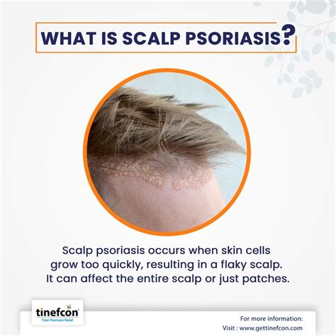 What Is Scalp Psoriasis Psoriasis Scalp Psoriasis Psoriasis Skin Care
