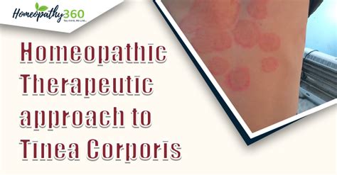 Therapeutic Approach Of Tinea Corporis Homeopathy360