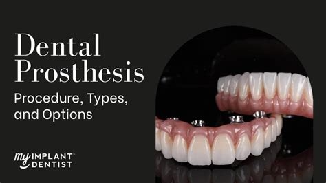 Dental Prosthesis Procedure Types And Options