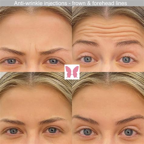 Anti Wrinkle Injections Treatment By Facekind In Billericay Essex