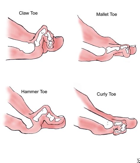 Splinting the hammer toe to keep it straight, stretch out the tendons and muscles of the toe and the foot Images Result, One Anders, Anders Teenproblemen, Google ...