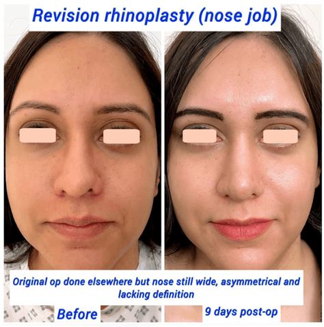 How Can Wearing Glasses Impact Your Rhinoplasty Results Harley Clinic