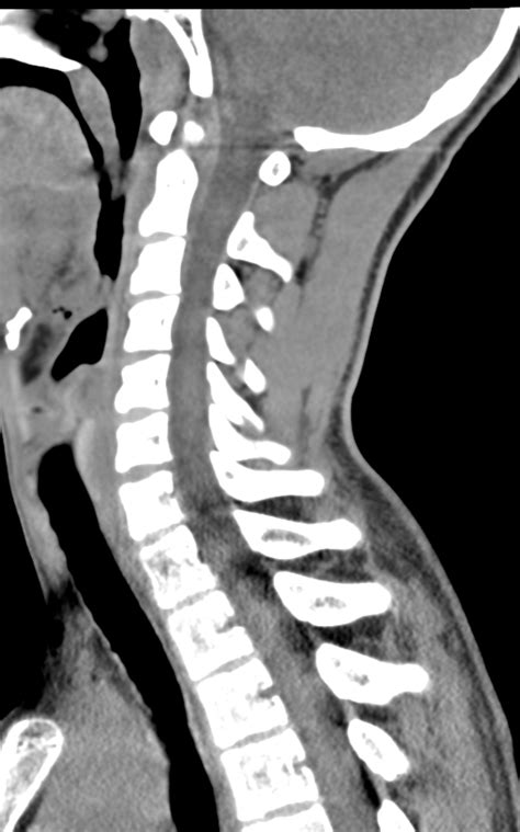 Normal Ct Cervical Spine Image