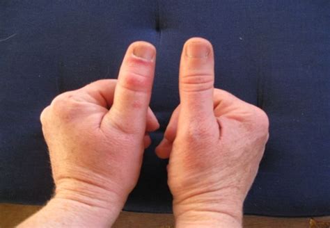 Pin On Thumb Basal Joint Arthritis