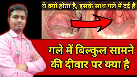 Granular Pharyngitis गले में लाल लाल दाने दिखाई देना Throat Infection