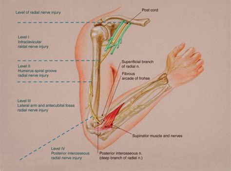 Radial Nerve Injury Hand2shoulder Clinic
