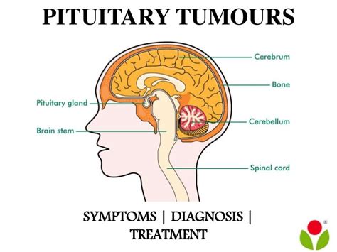 pituitary tumours symptoms diagnosis and treatment