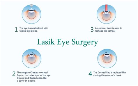 Lasik Eye Surgery Near Boynton Beach And Lake Worth Fl