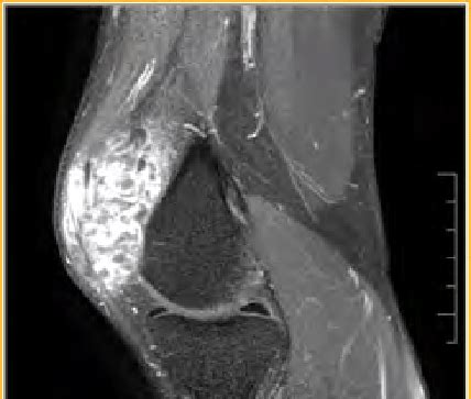 MRI left knee showing lipoma arborescens showing fat suppression on... | Download Scientific Diagram