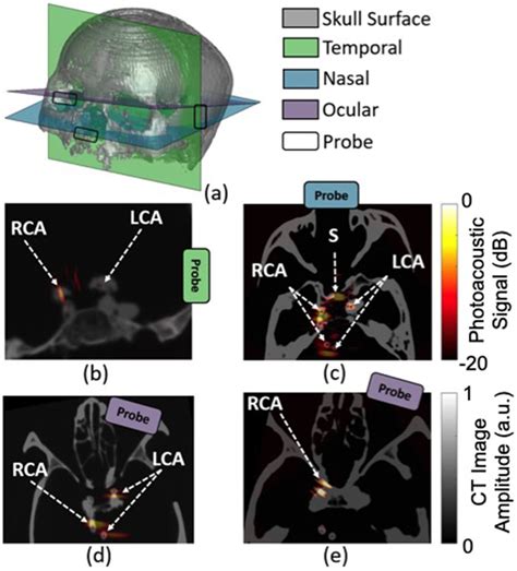 A 3d Computed Tomography Ct Skull Reconstruction Highlighting The