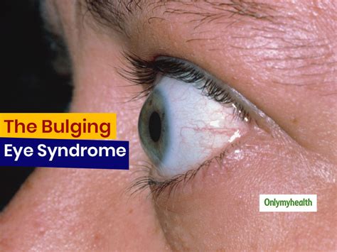 Bulging Eyes Can Be More Than Just Beautiful It Can Be A Medical