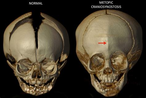 They are short in stature and have a broad, short skull; Pediatric Metopic Synostosis