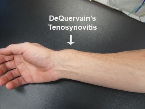 De Quervains Tenosynovitis Surgery Kulturaupice