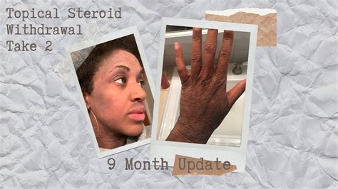 Topical Steroid Withdrawal Take Two Nine Month Update Youtube