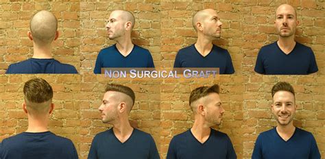 Non Surgical Hair Transplant For Men At The Hair Clinic Montreal