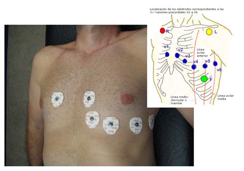 Aprende Aplicar Los Electrodos Ecg Video Medicina Mnemotecnias