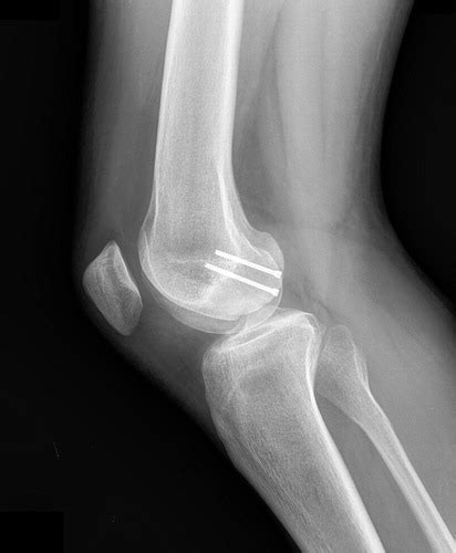 Fracture Of The Lateral Femoral Condyle Journal Of Orthopaedic
