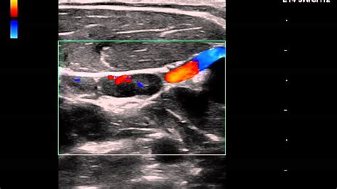 Ultrasound Clip Normal Lymph Node Youtube