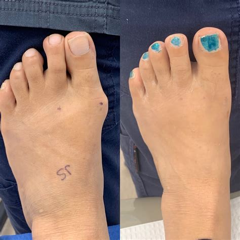 Before And After Bunion Surgery Photos Northwest Surgery Center