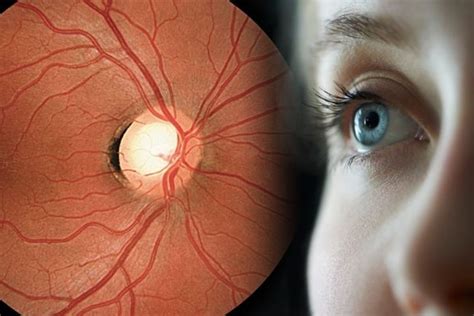 Eye Condition Glaucoma Symptoms Treatments The Eye News