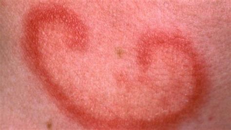 Pictures Of Rashes On Adults Pictures Photos