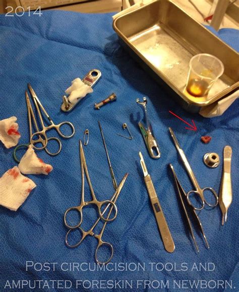 Pin on Circumcision