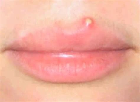 Pimple On Lip Line With Images Pimples On Lip Line How To Line