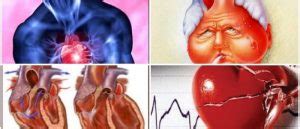 Insuficiencia Cardíaca Congestiva Definición Tipos más Comunes y