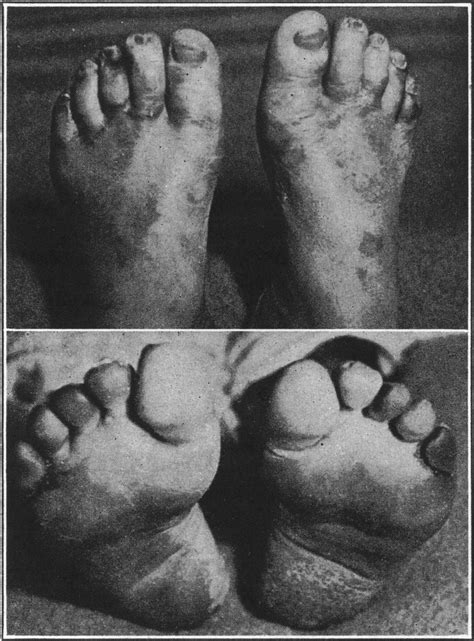 Trench Foot And Immersion Foot Nejm
