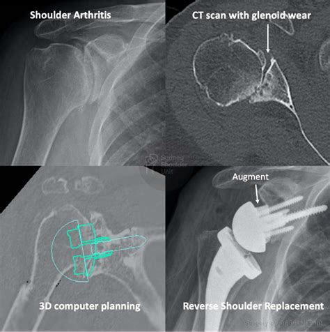 Reverse Shoulder Replacement Medical Case Study Sydney Shoulder Unit