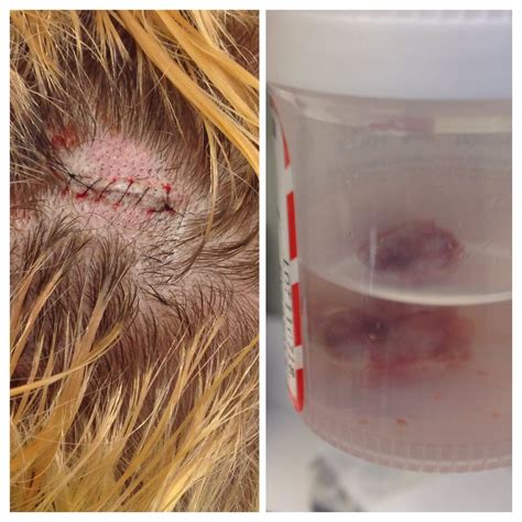 It took 20 minutes to pry this quarter sized pilar cyst out of my scalp