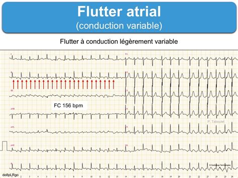 Atrial Flutter With Conduction Then Conduction Vrogue Co