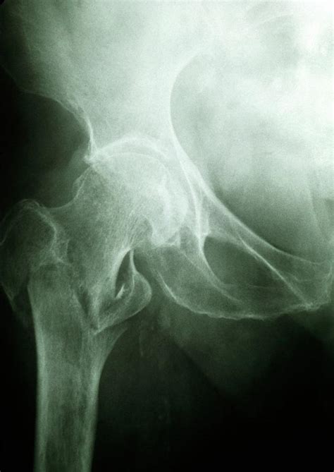 X Ray Of A Hip Fracture Due To Osteoporosis Photograph By Medical Photo