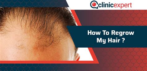 How To Regrow My Hair Clinicexpert